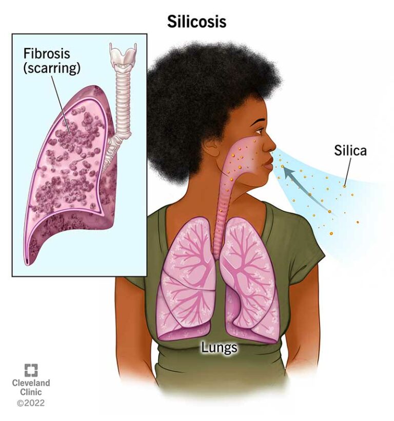 Silicosi Cause Sintomi Diagnosi E Trattamento Sfomc