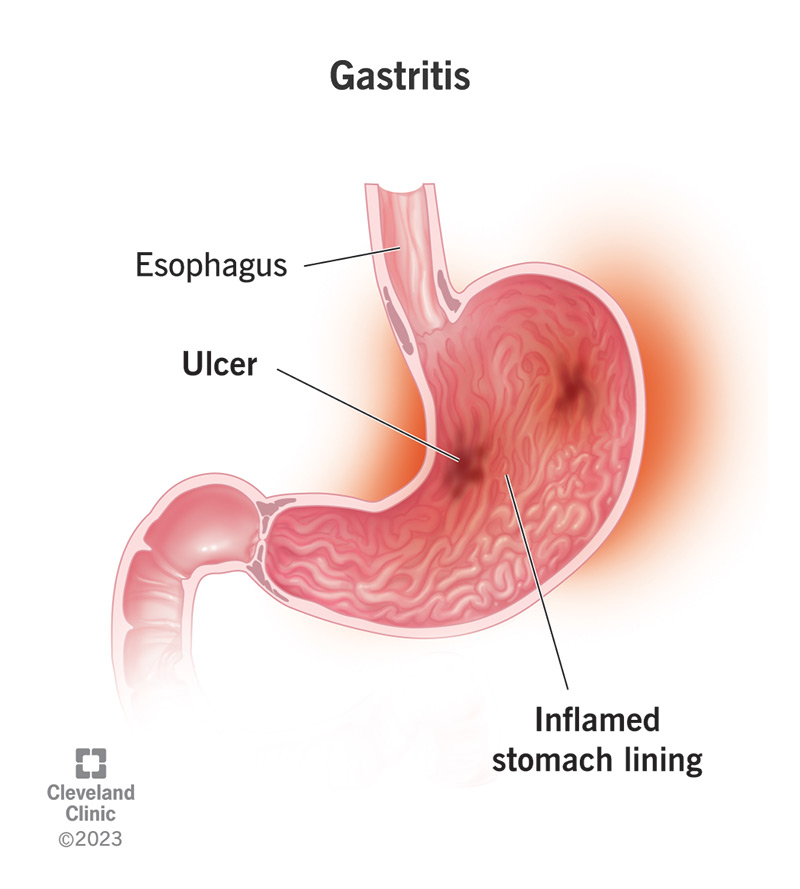 10349 gastritis