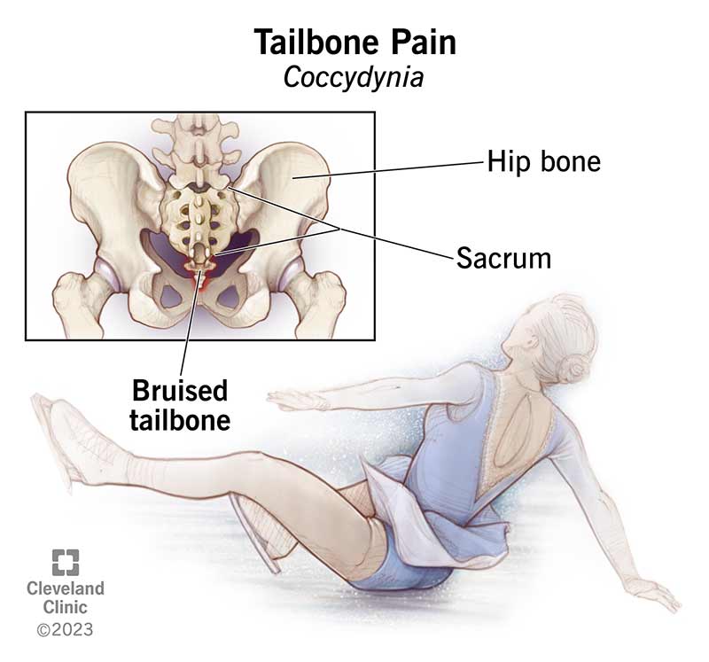 10436 coccydynia tailbone pain