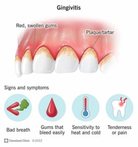 10950 gingivitis