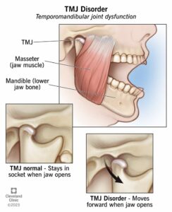 15066 tmj disorder