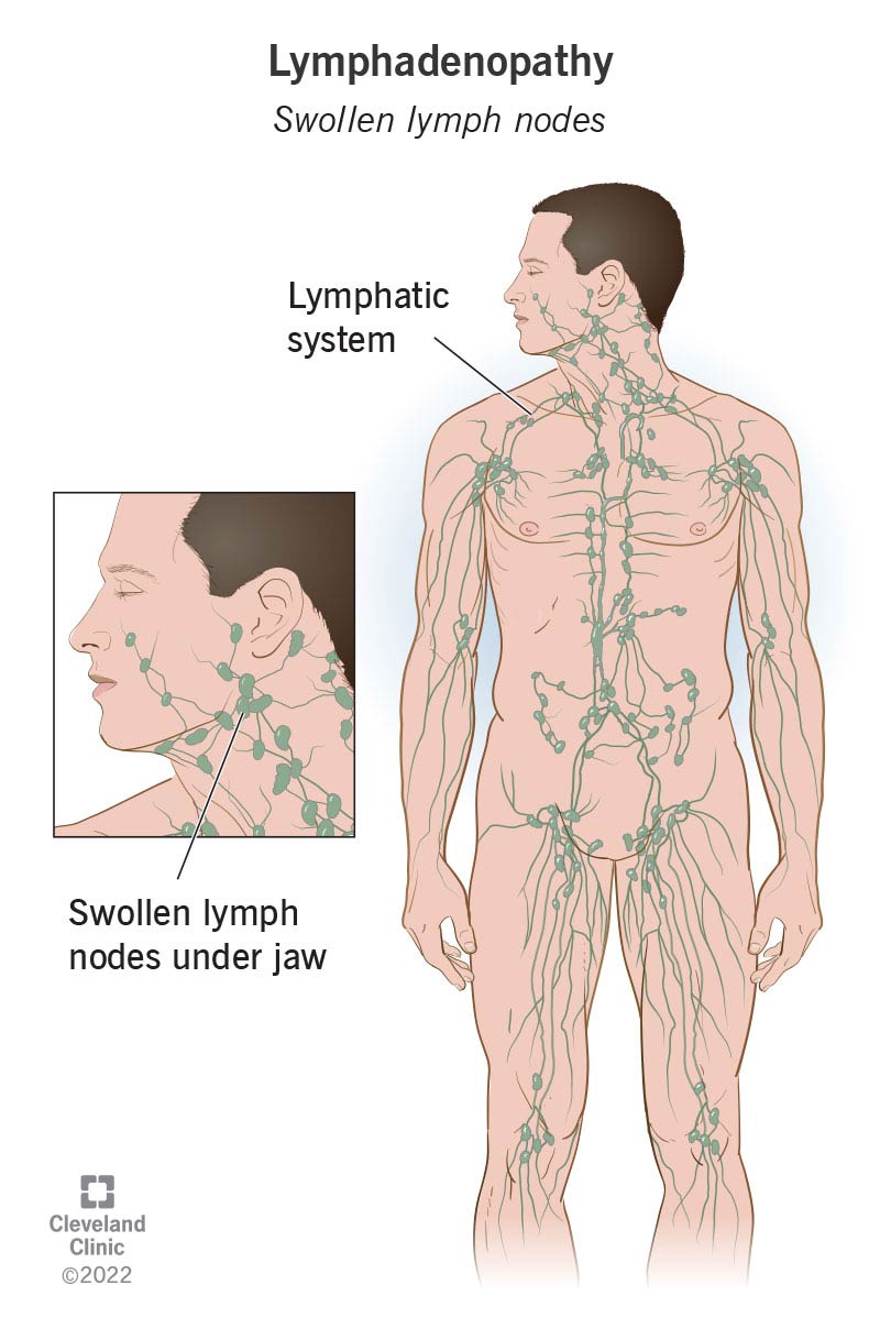 I linfonodi ingrossati sono la reazione naturale del corpo a malattie o infezioni.  I linfonodi fanno parte del tuo sistema linfatico.
