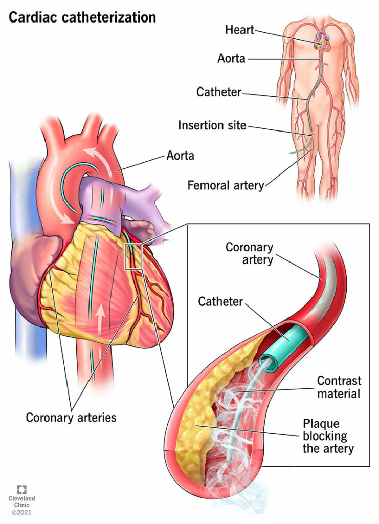 16832 cardiac catheterization
