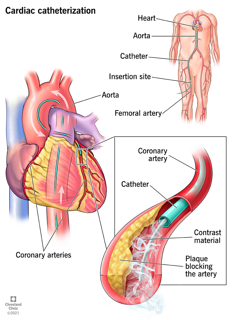 Il cateterismo cardiaco è una procedura invasiva per valutare la funzionalità cardiaca.