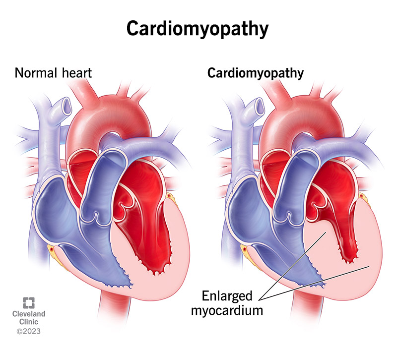 16841 cardiomyopathy illustration