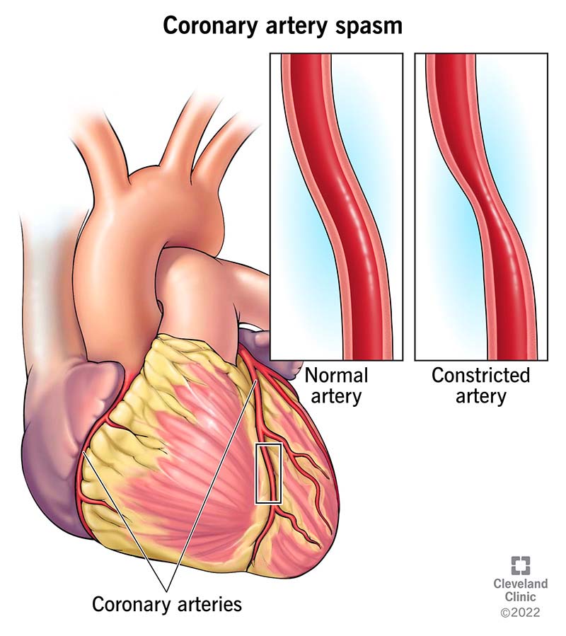 16900 coronary artery spasm