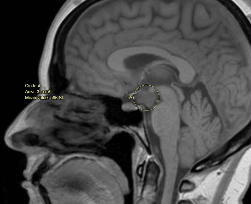17118 hypothalamic hamartoma