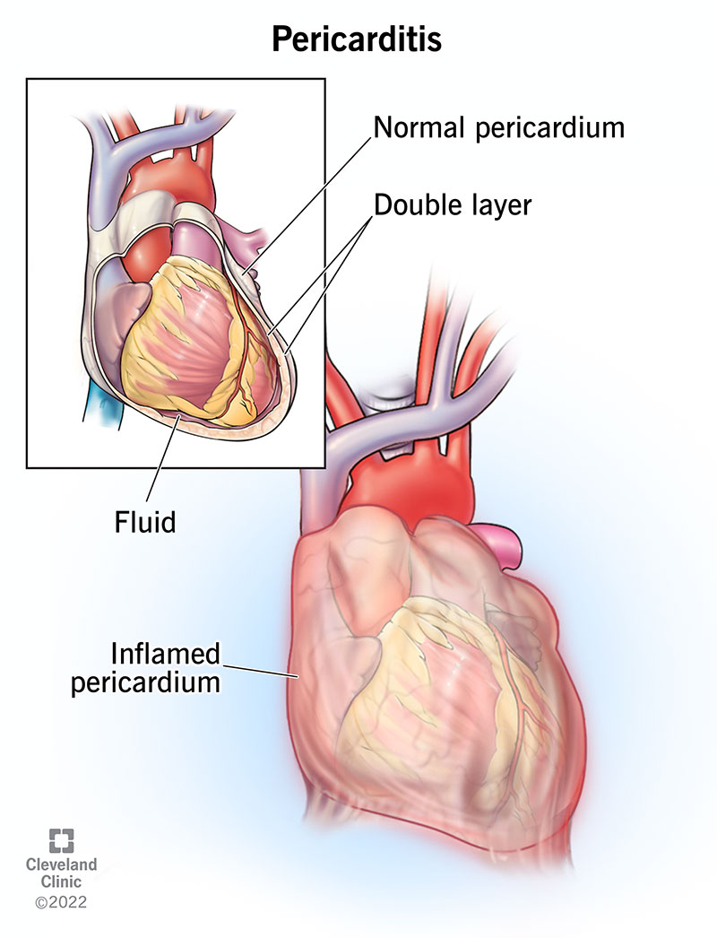 Illustrazione che mostra il pericardio infiammato.
