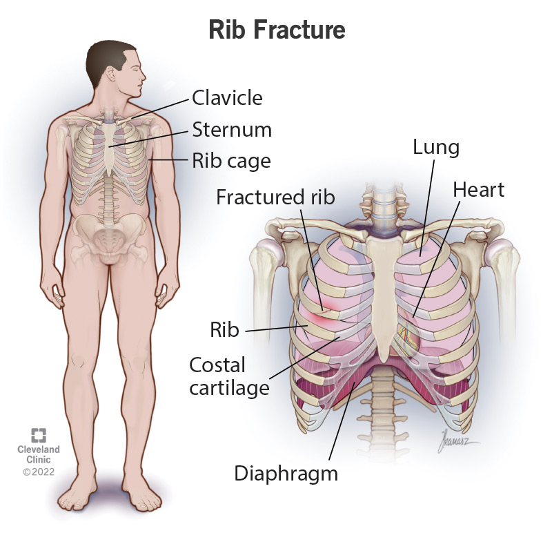 17434 rib fracture