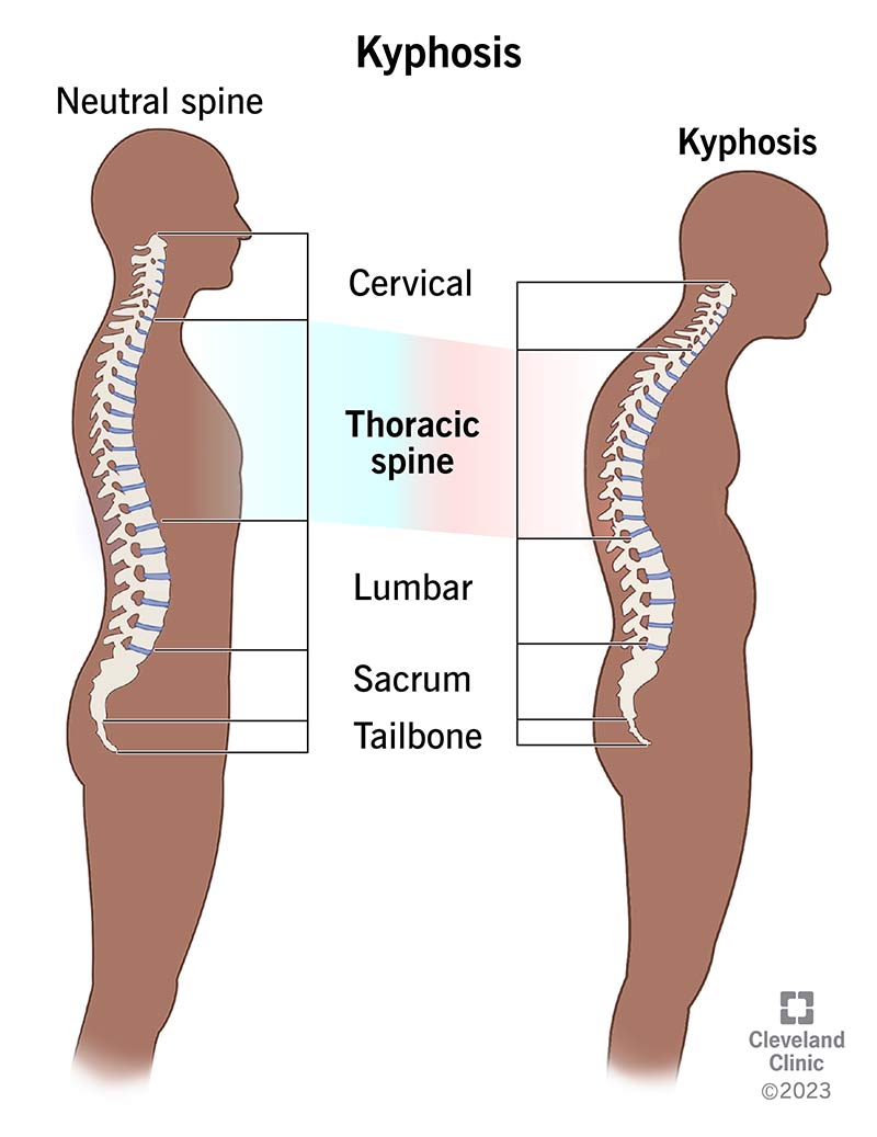 Una colonna vertebrale naturale e una colonna vertebrale curva con cifosi.
