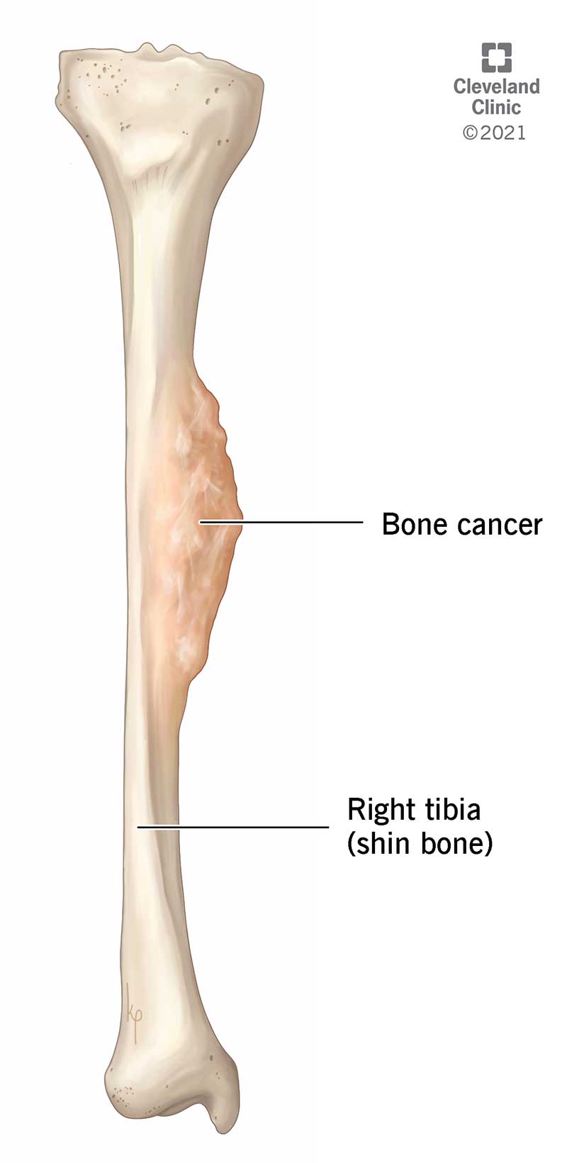 Il cancro osseo è definito come una massa di cellule benigne o cancerose che crescono in un osso.