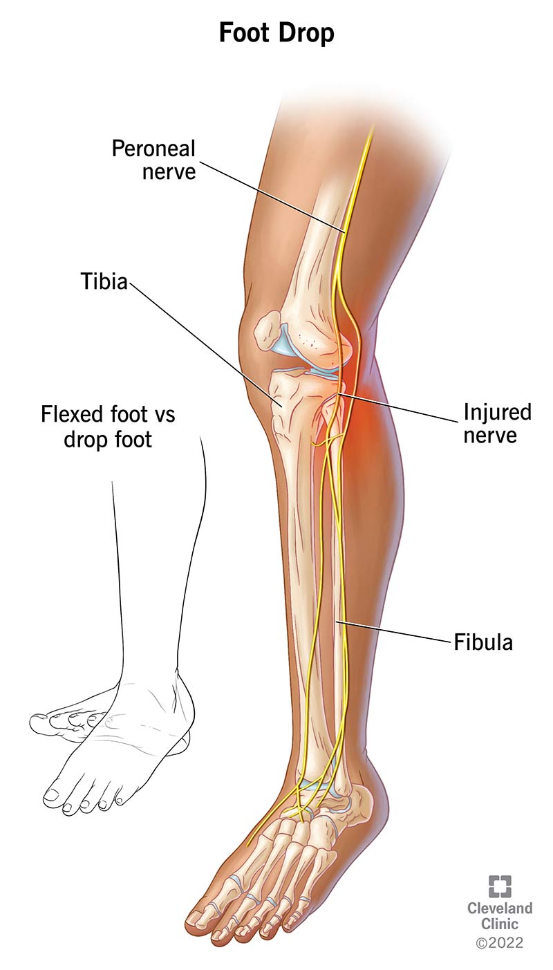 Illustrazione delle ossa delle gambe e del nervo peroneo.  Lesioni comuni intorno al ginocchio e alla caviglia.