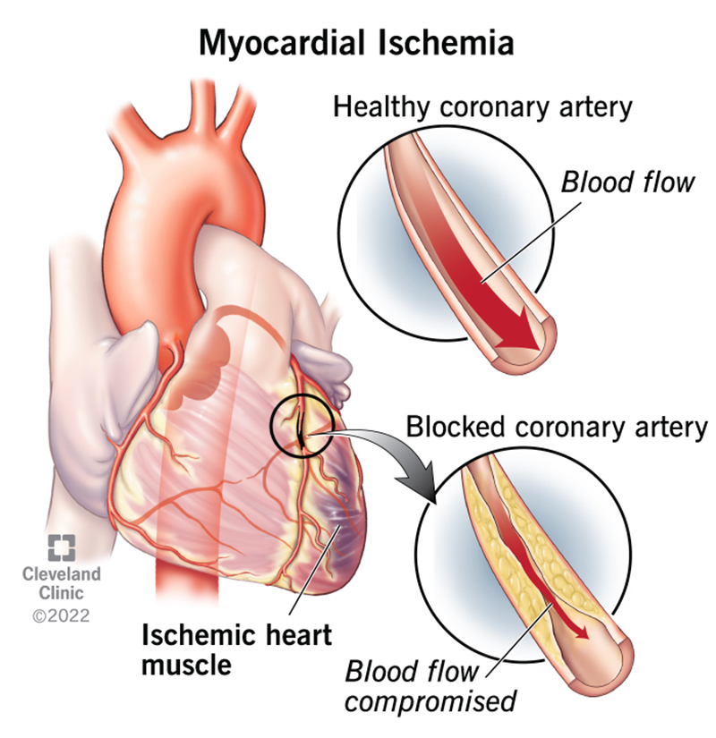 17848 myocardial ischemia