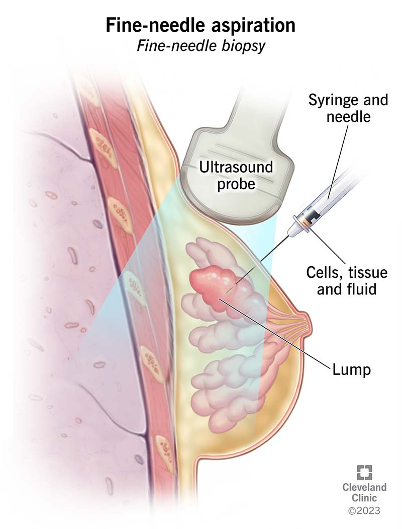 Illustrazione che mostra un ago e una siringa che aspirano il fluido da un nodulo nel tessuto mammario.  Mostra anche una sonda ecografica.