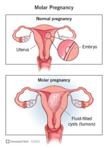 17889 molar pregnancy