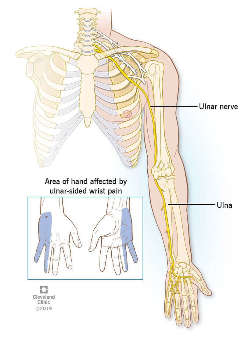 La posizione del nervo ulnare in un essere umano va dal collo, al braccio inferiore, al mignolo.  L'immagine nel riquadro mostra il lato anteriore e posteriore della mano affetto da dolore al polso sul lato ulnare.