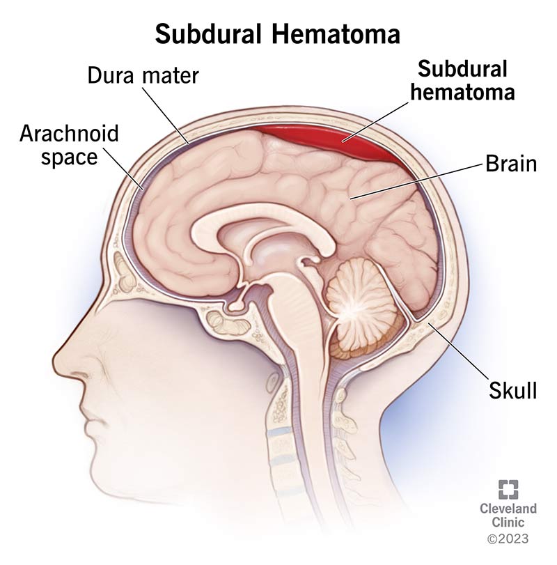 21183 subdural hematoma