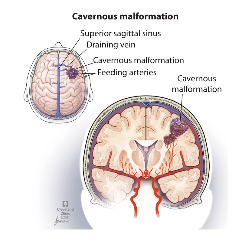 21594 brain cavernous malformation