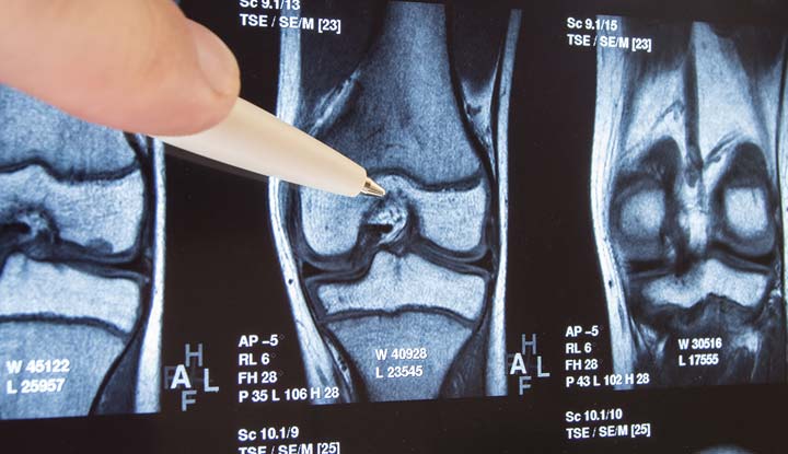 21750 osteoarthritis knee