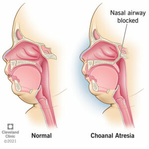 21865 choanala atresia