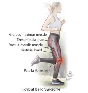 21967 Iliotibial band syndrome