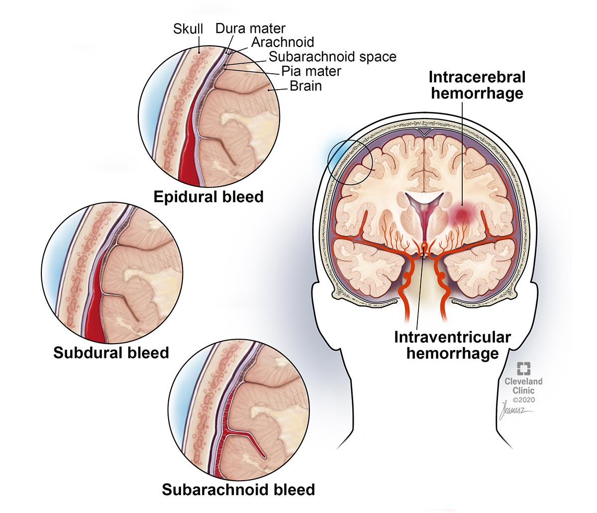Un ematoma epidurale è un'emorragia cerebrale tra il cranio e la membrana che copre il cervello.