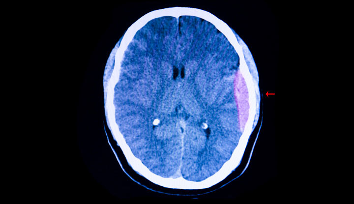 La scansione del cervello mostra una riserva di sangue che si raccoglie e spinge il tessuto cerebrale lontano dal cranio.