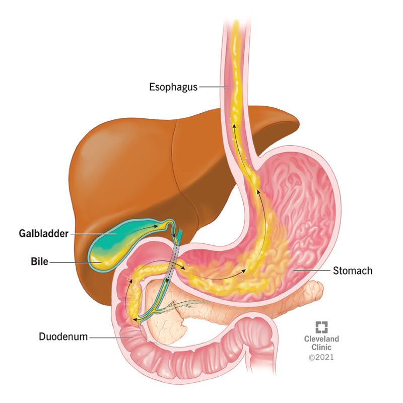 Il reflusso biliare si verifica quando la bile dall’intestino tenue rifluisce nello stomaco e talvolta nell’esofago.