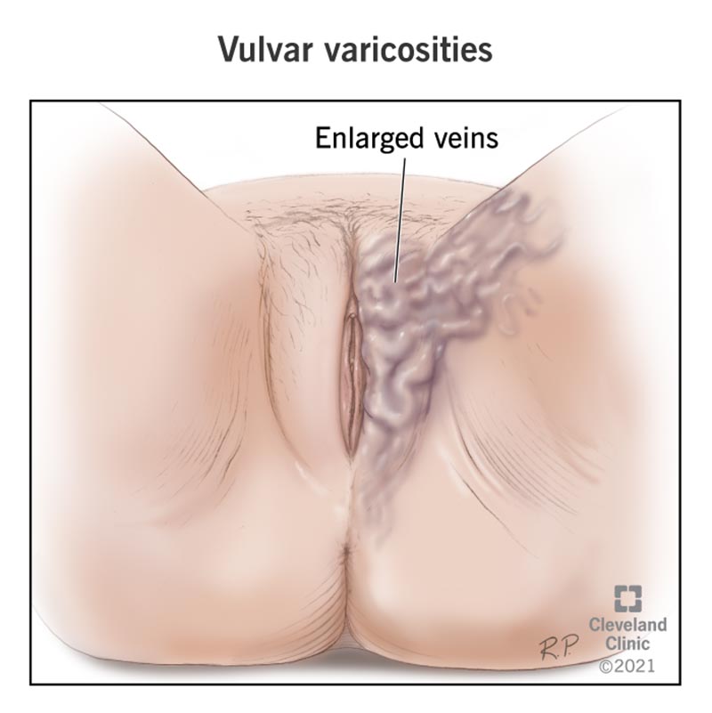 22127 vulvar varicosities