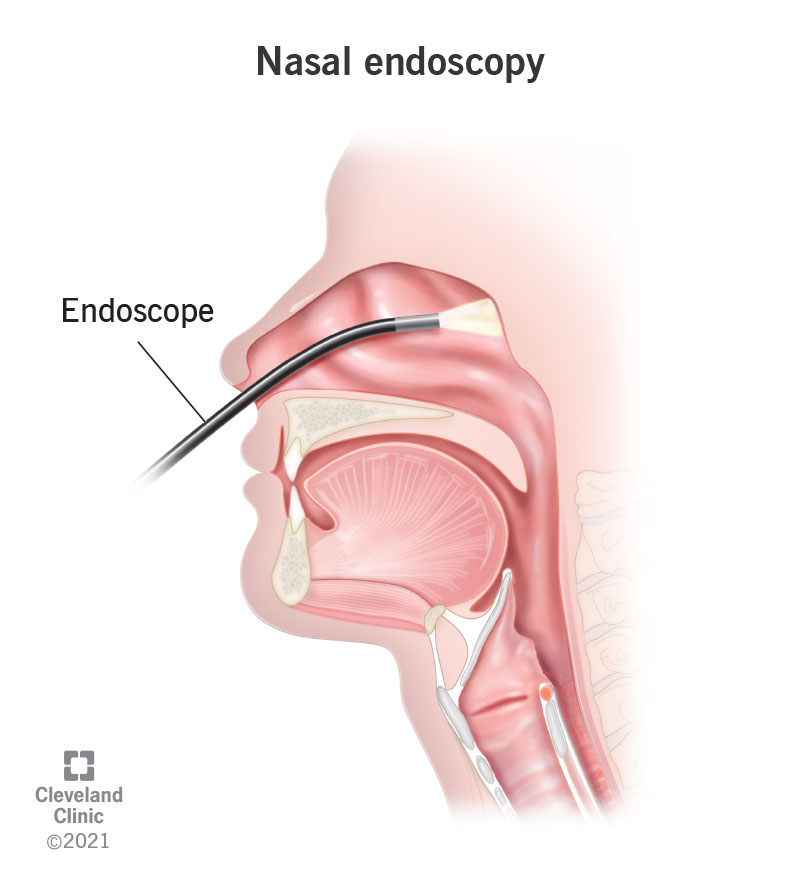 22156 nasal endoscopy
