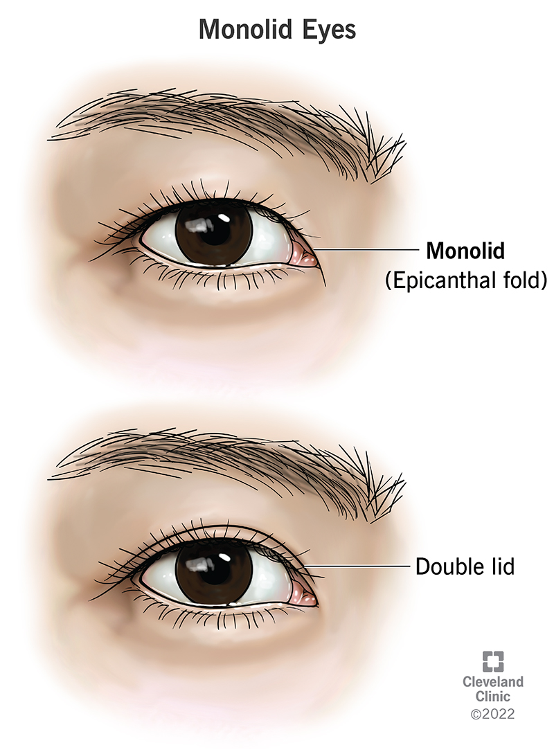 Gli occhi monolidi (pieghe epicantali) non hanno pieghe tra le ciglia e le sopracciglia.  Le doppie palpebre hanno queste pieghe.