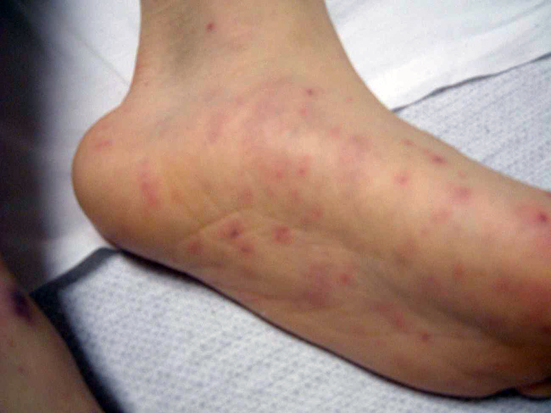 Mani e piedi sono ricoperti da un'eruzione petecchiale che assomiglia a macchie di sangue dovute alla malattia meningococcica.