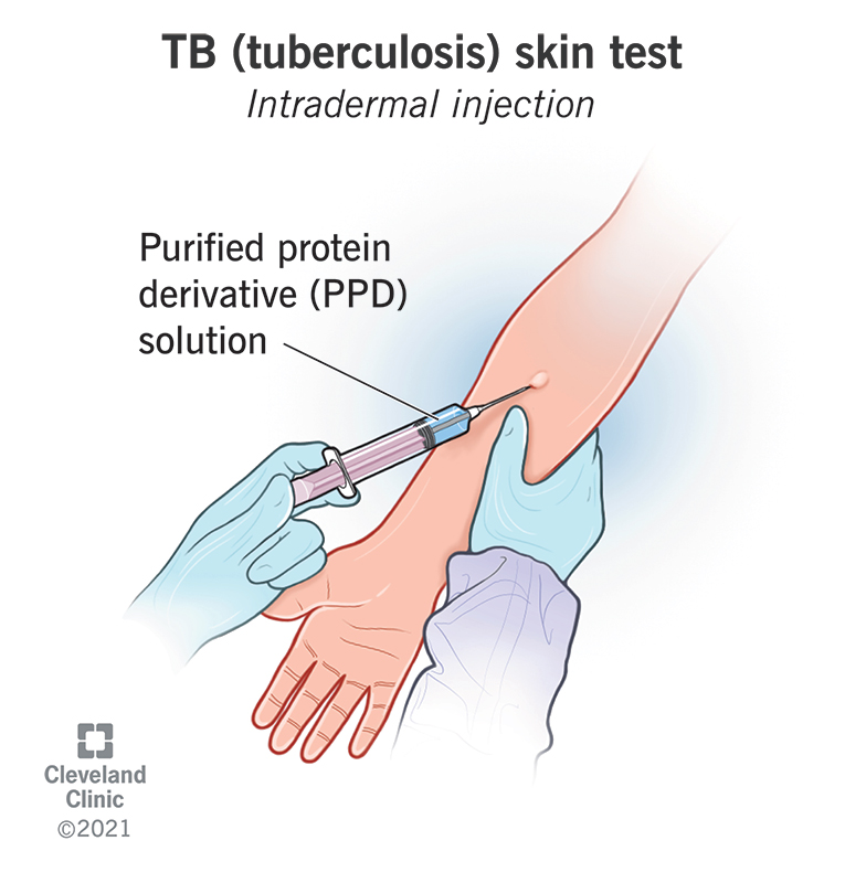 22751 tuberculosis