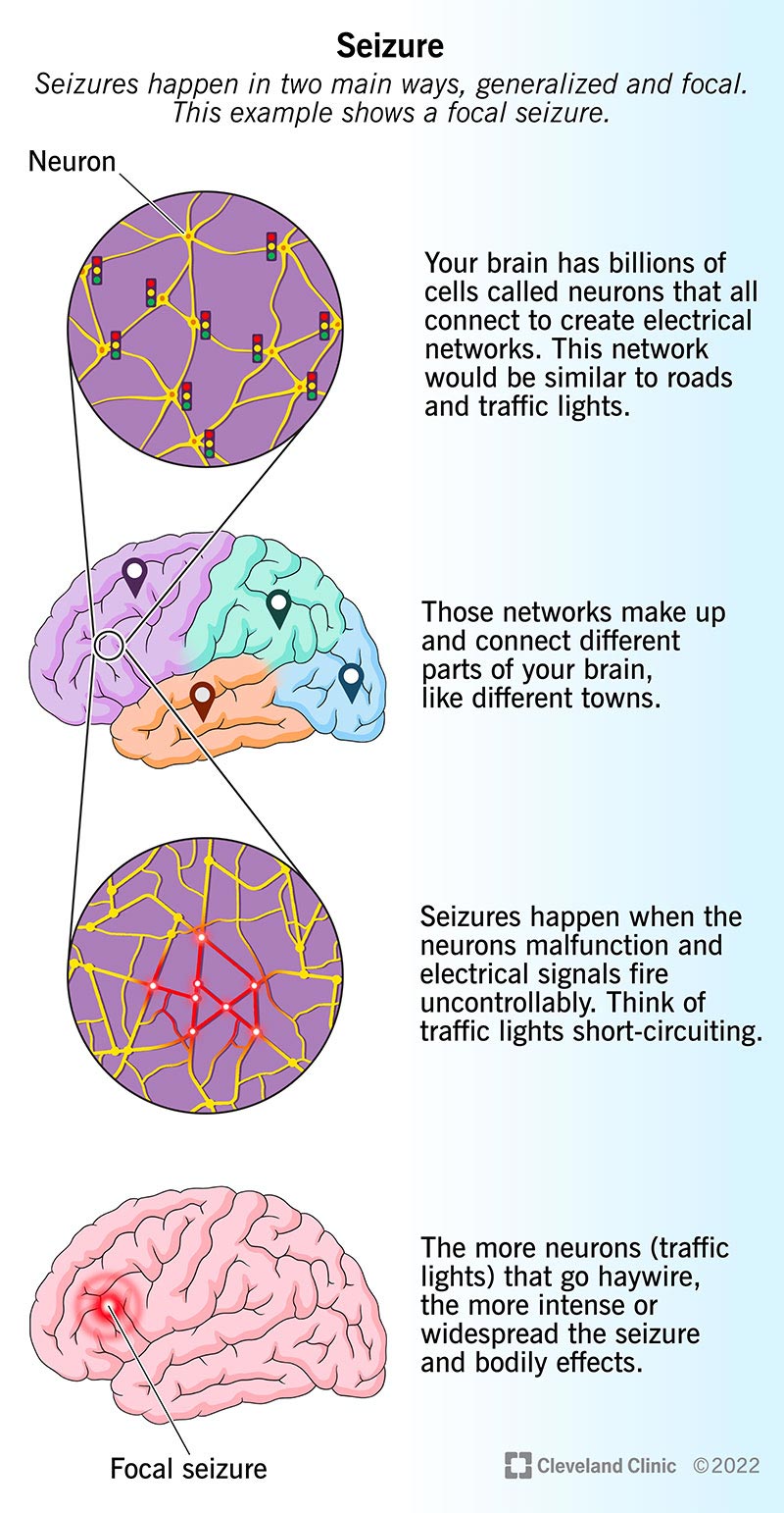 Le reti neurali nel cervello trasmettono segnali.  Le convulsioni interrompono questo flusso elettrico.