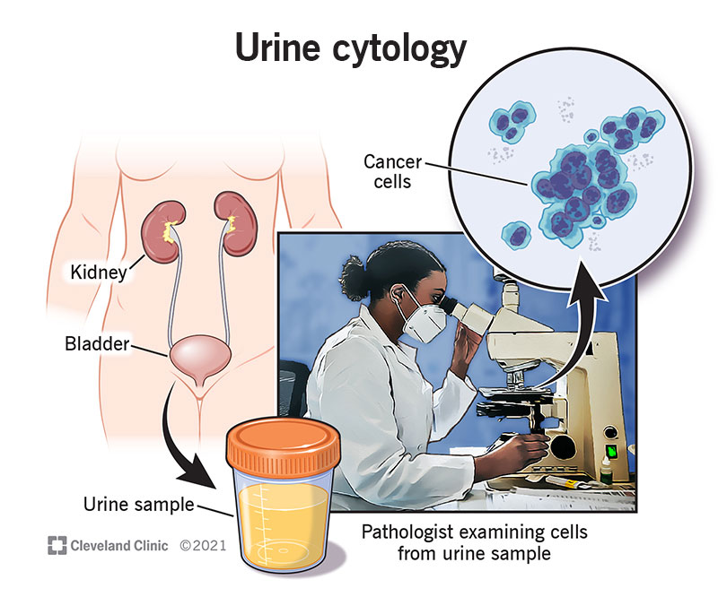 22942 urine cytology