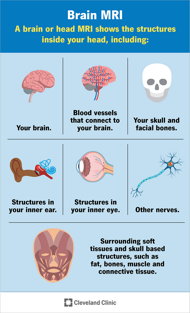 Una risonanza magnetica del cervello o della testa mostra il cervello, i vasi sanguigni, il cranio, le strutture dell'orecchio interno e dell'occhio interno e altro ancora.