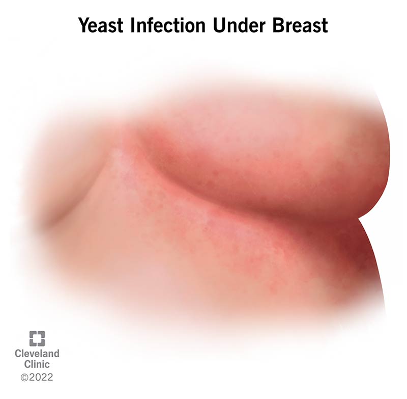 22970 yeast infection under breast