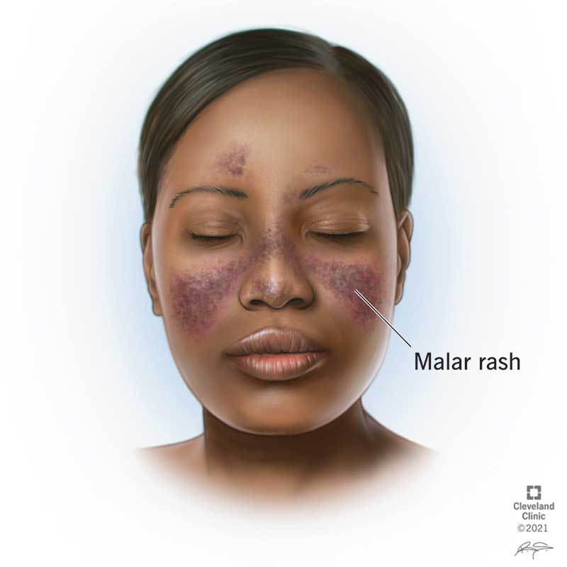 23163 lupus rash