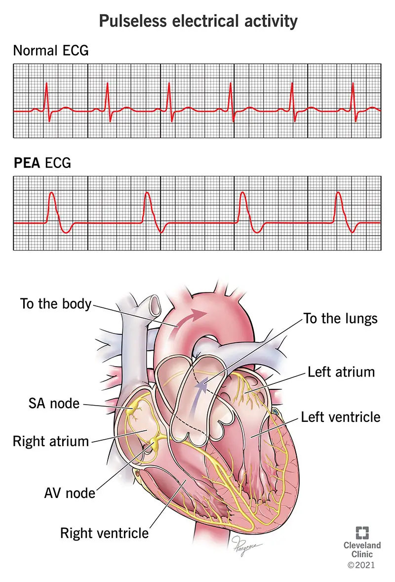 ECG che illustra l'attività elettrica senza polso (PEA)