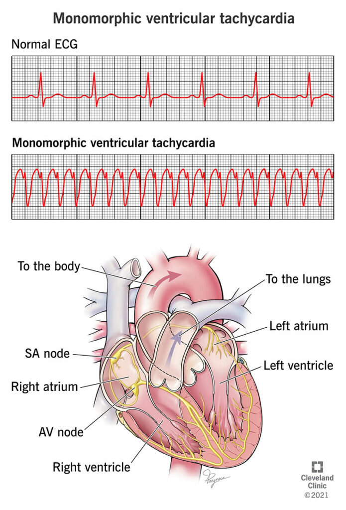 23215 monomorphic ventricular tachycardia