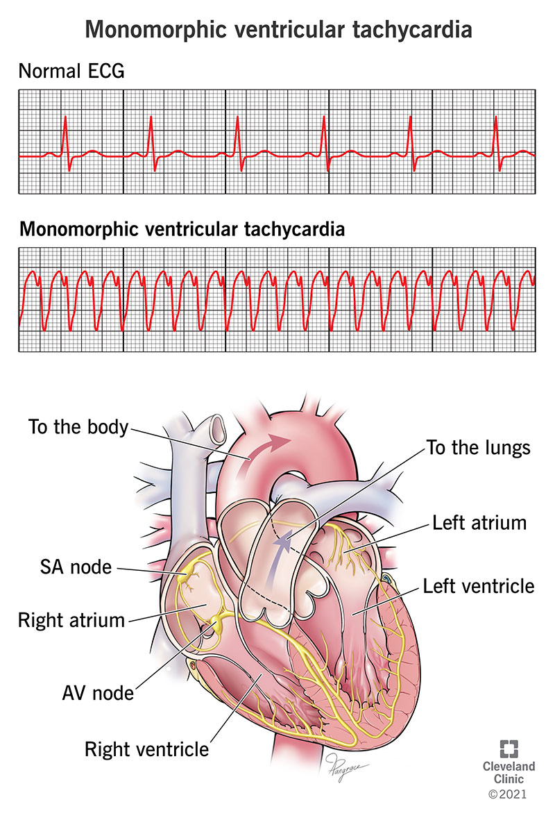 Un ECG che mostra tachicardia ventricolare monomorfa.