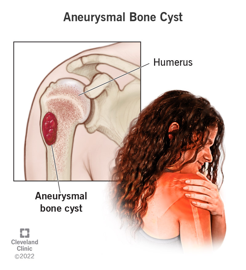 23413 aneurysmal bone cyst