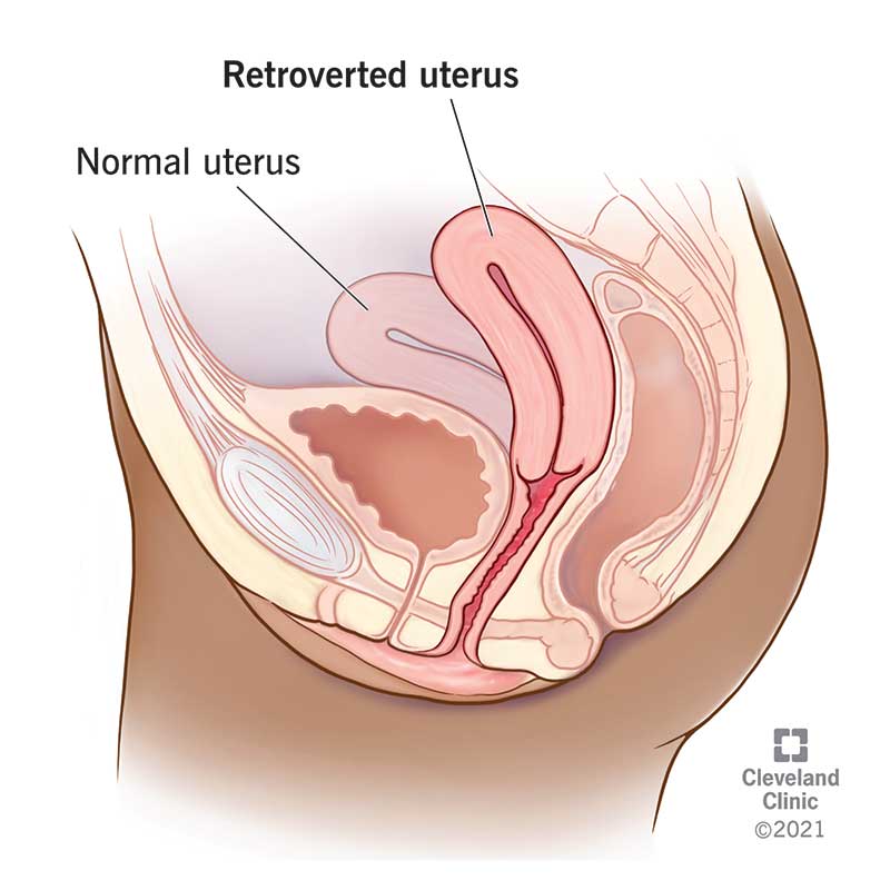 23426 retroverted uterus