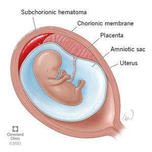 23511 subchorionic hematoma