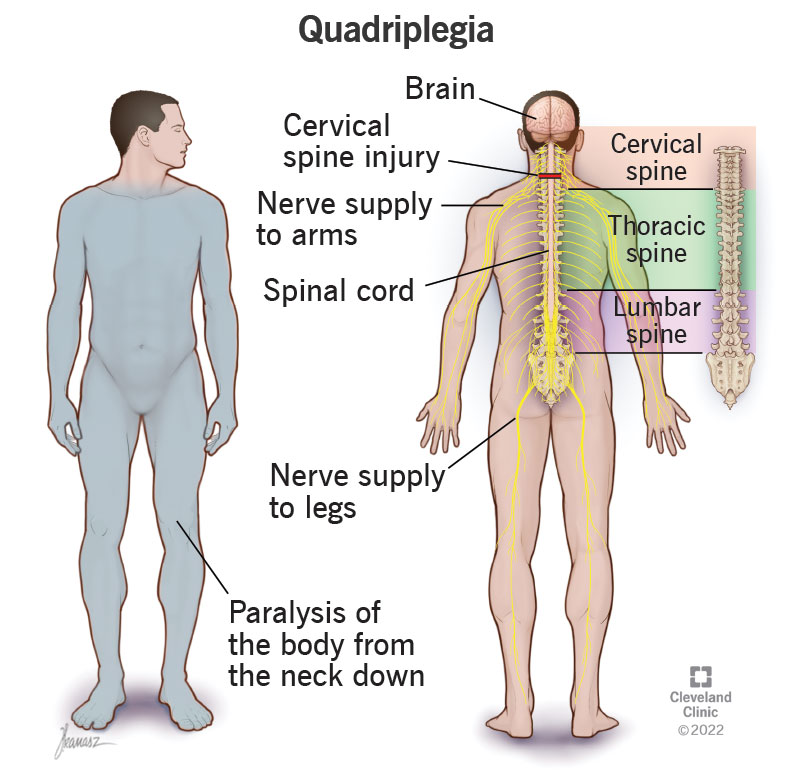 23974 quadriplegia