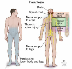 23984 paraplegia