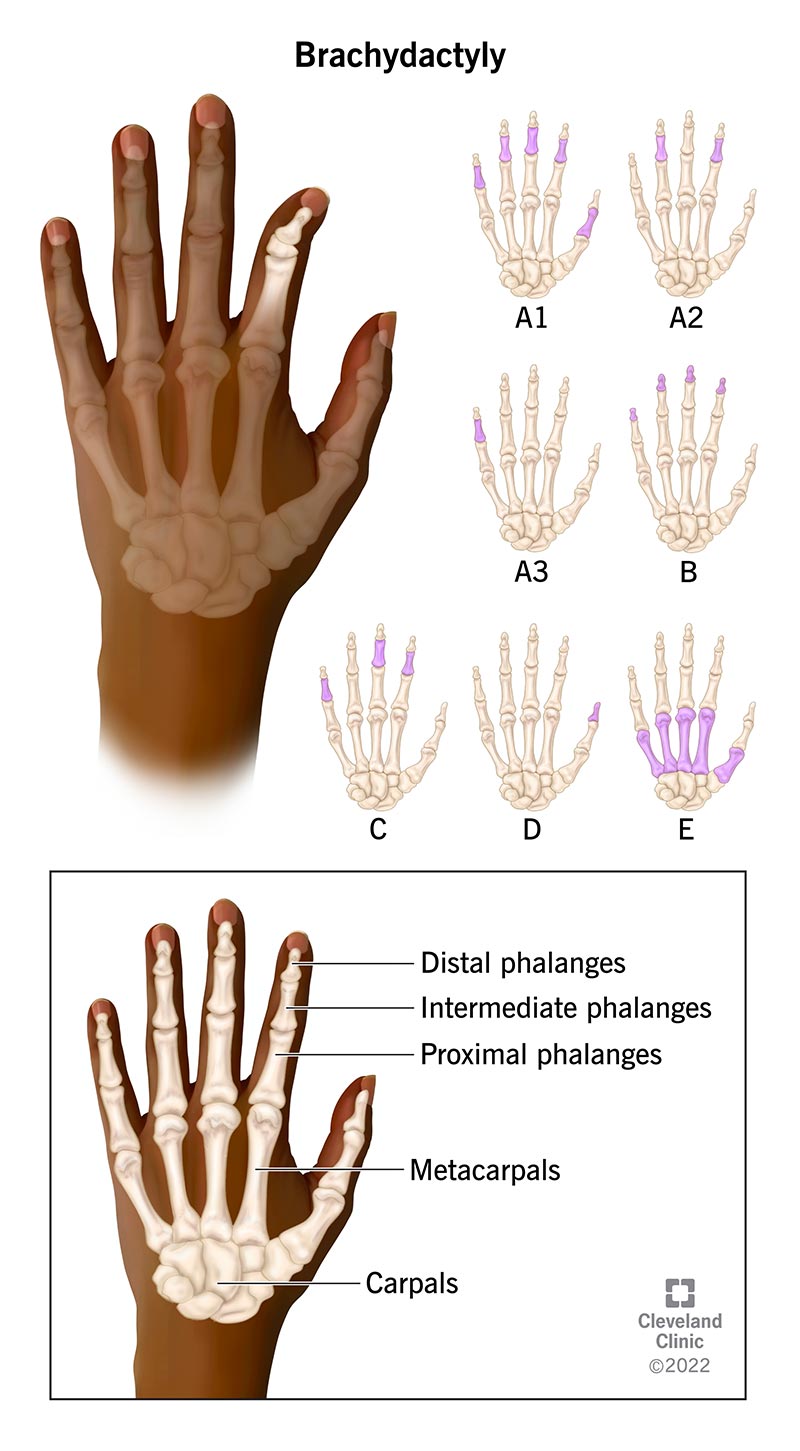 Una mano con le dita corte causata dalla brachidattilia.