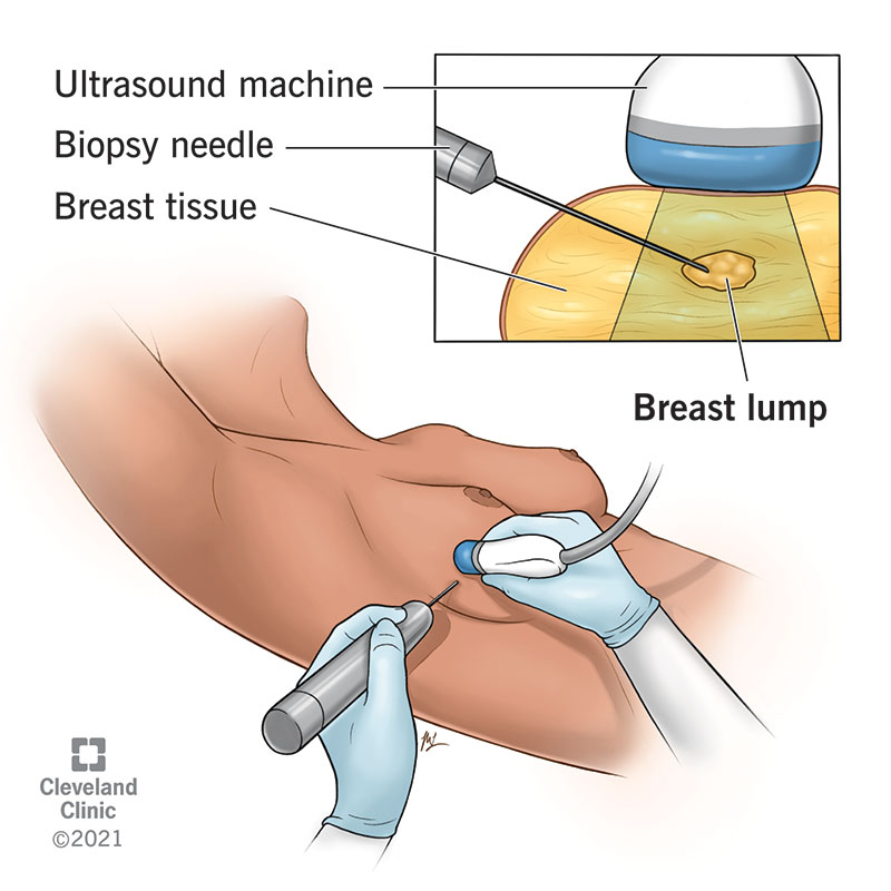 24204 breast biopsy