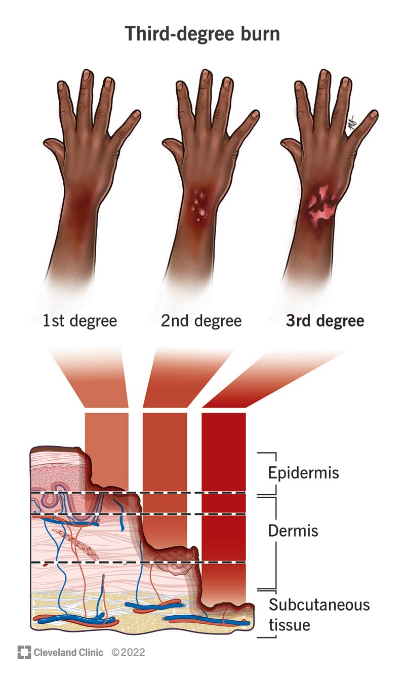 Tre mani che mostrano ustioni di primo, secondo e terzo grado sul polso e sugli strati di pelle colpiti.