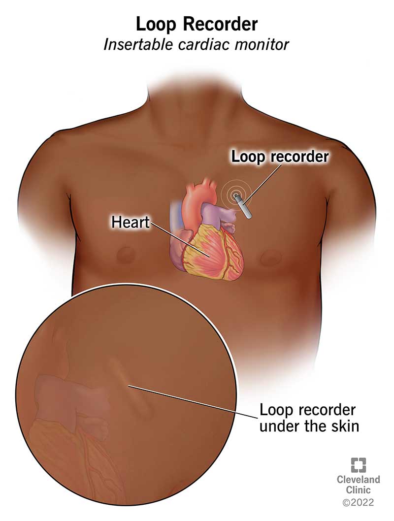 Il registratore di loop si trova nel petto.  È posizionato proprio sotto la pelle.